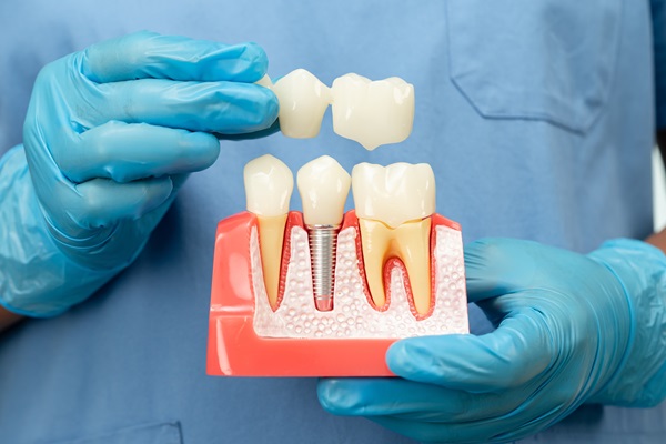 A Dental Implant And Crown For A Single Missing Tooth